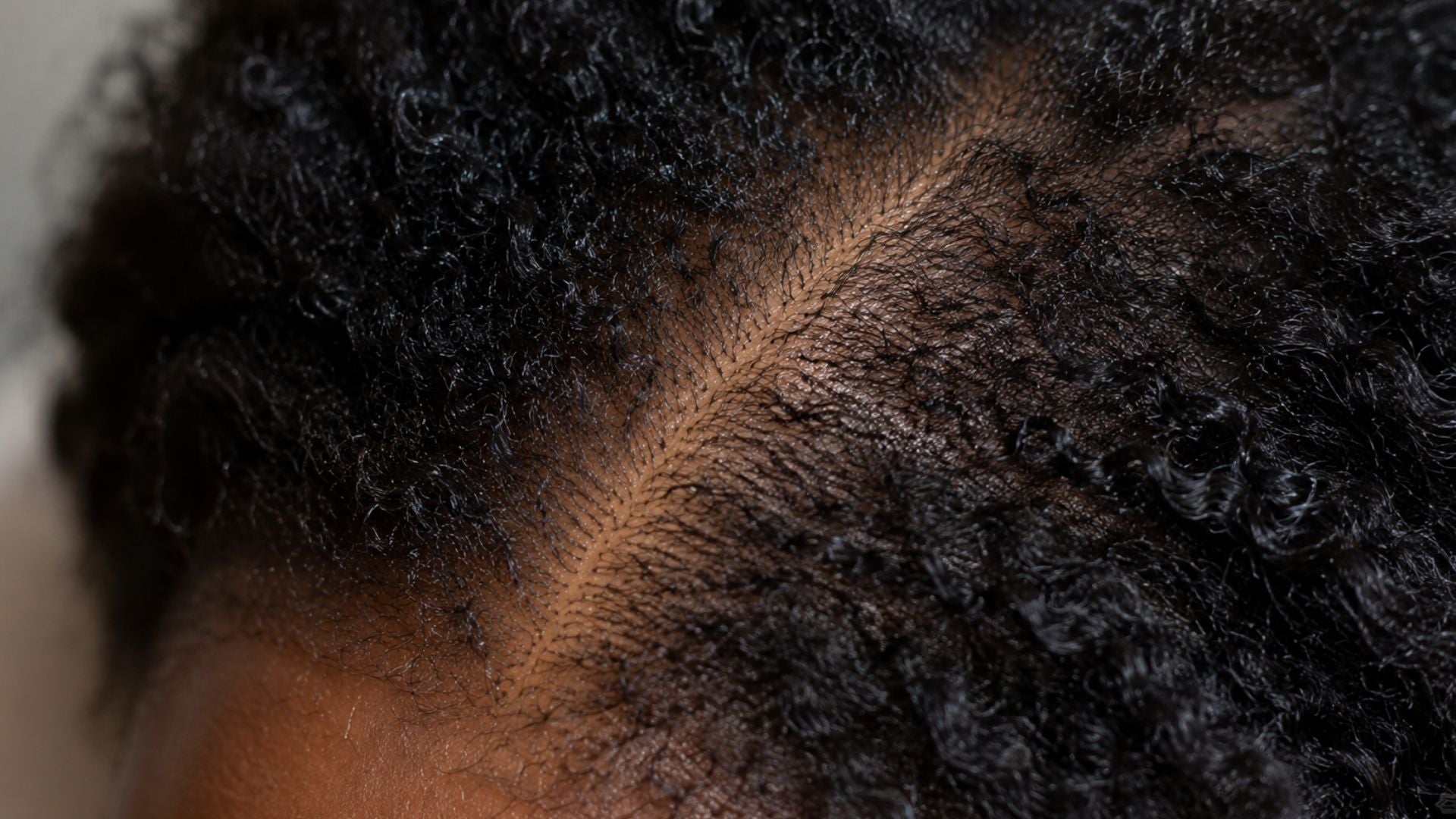 Afro and curly scalp care in winter: preventing dryness, irritation, and dandruff